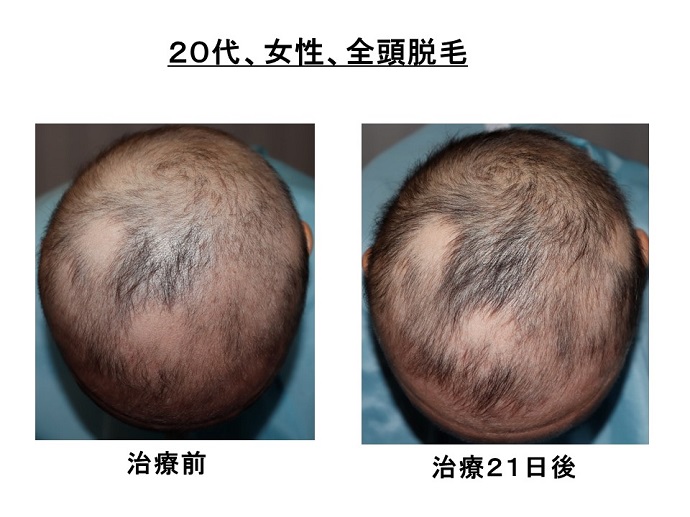 円形脱毛症　病院